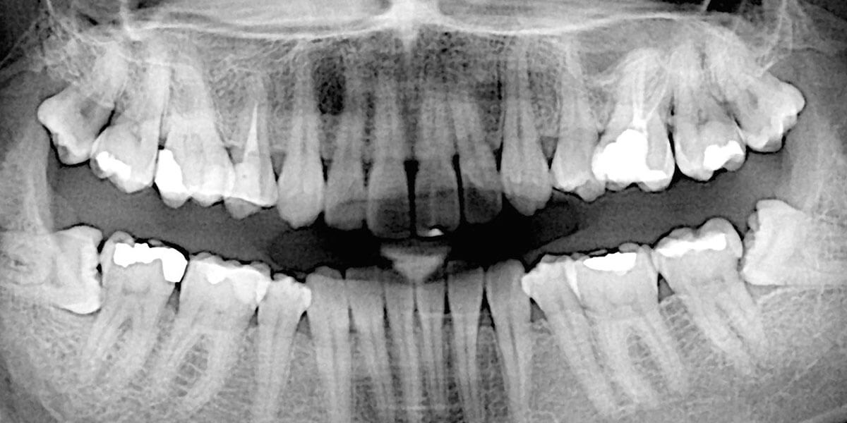 xray showing impacted wisdom teeth